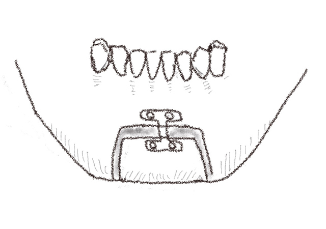 オトガイ舌筋前方牽引術